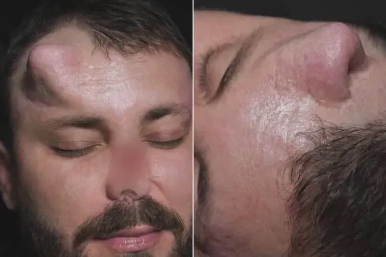 An Iraqi surgeon (Dr. Diyar Abdulwahid) successfully grew a temporary nose on a patients's forehead to reconstruct his face after losing a 99% of his nose to a severe electric schock