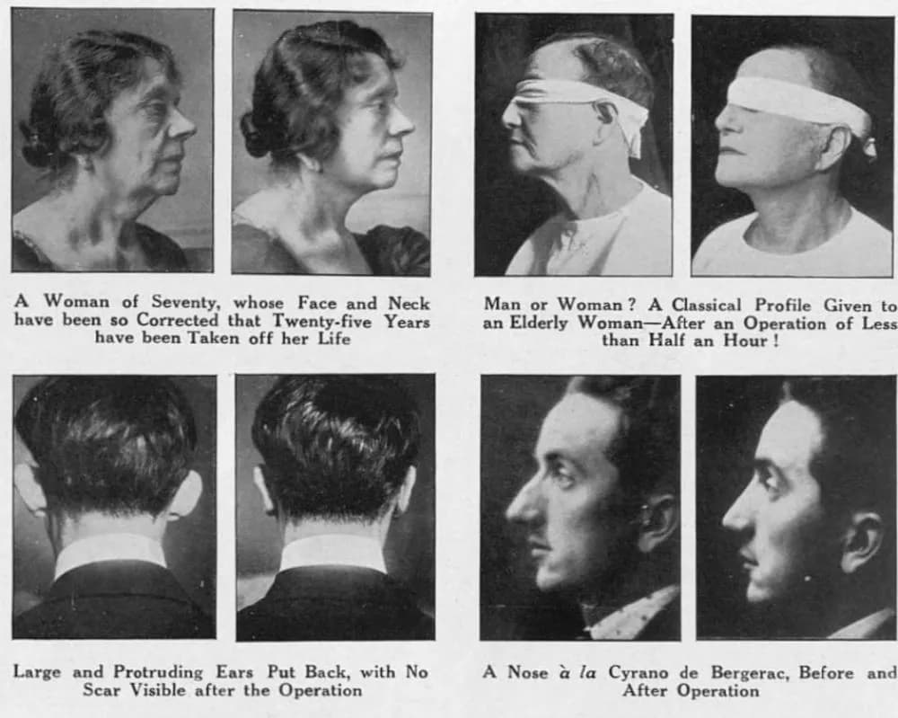 Examples of what could be done with plastic surgery in the 1920s.