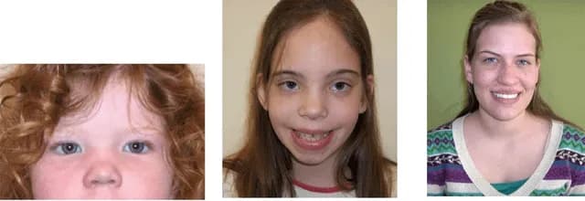 TIL ~1 in 1,000 females have Trisomy X (extra X chromosome). It's rarely diagnosed; fewer than 10% know they have it. They can have learning disabilities, wide-spaced eyes, incurved little fingers, ea