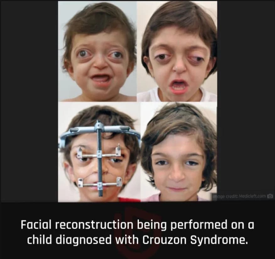 Before and after facial reconstruction for a child with Crouzon syndrome.