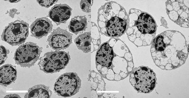 Researchers found a "genetic switch" that triggers neurodegeneration in both a rare childhood dementia and Alzheimer's disease due to waste build-up in microglia. They may now be able to prevent neuro