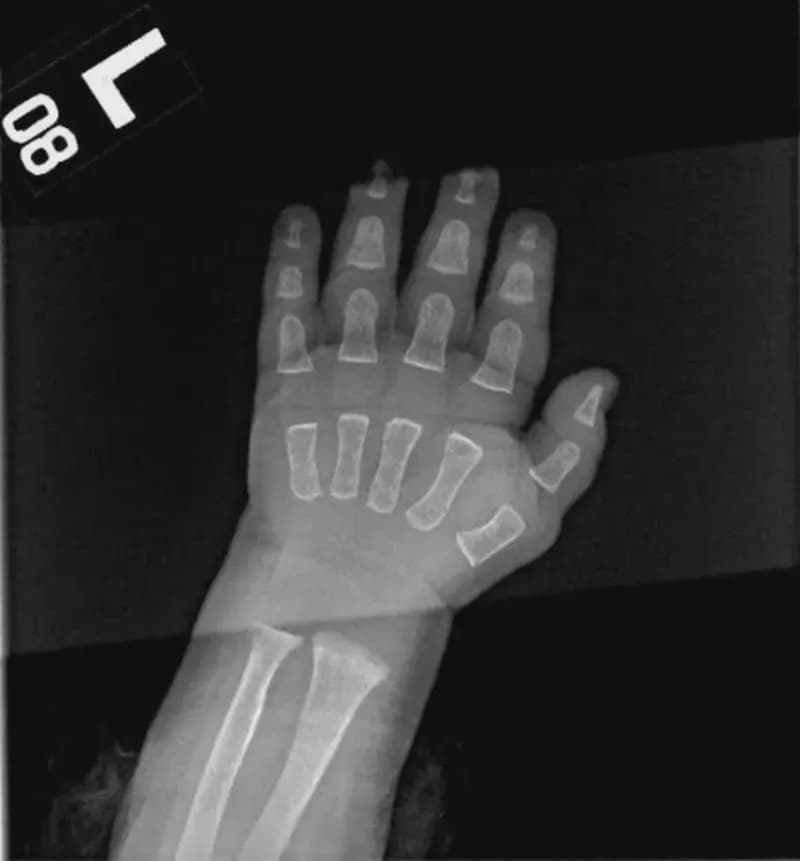 X-ray of the hand of a baby before the bones are fused