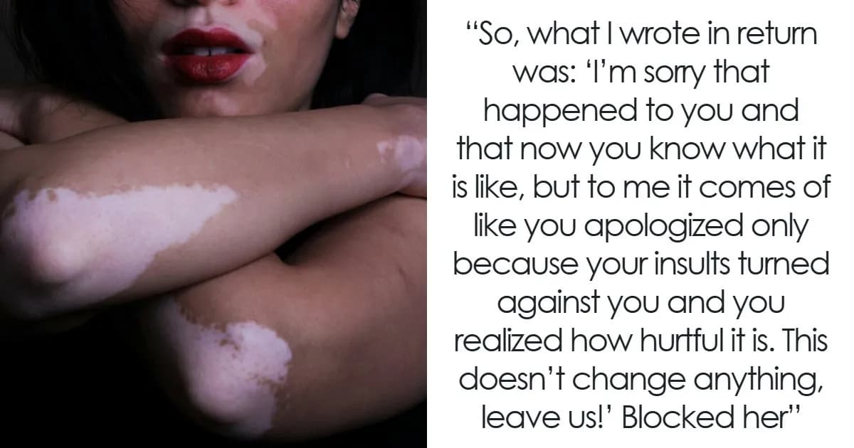Guy’s Mom Makes His GF’s Vitiligo Her Favorite Insult, Stops Laughing When She Develops It Herself