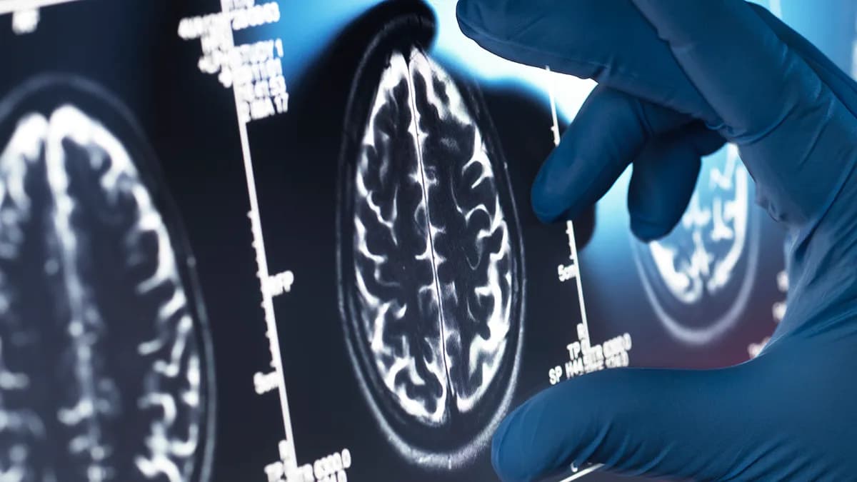 Brain Scans Reveal a Striking Similarity Between Schizophrenia And Bipolar Disorder