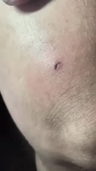 This Person Used a Powerful Magnet to Remove Shrapnel