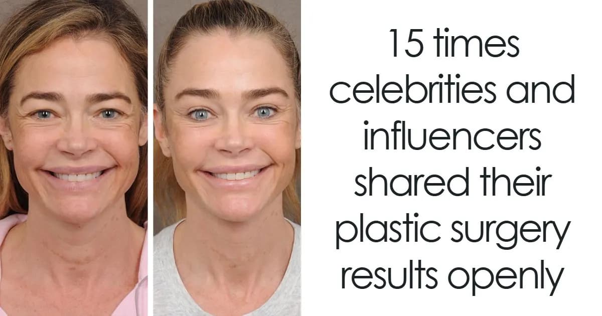 Famous People Who Shared Their Plastic Surgery Results Openly