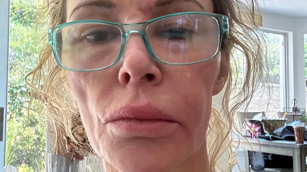 ‘Embarrassed’ Brandi Glanville Breaks Down Over Asking Fans For Money Amid Ongoing Facial Disfigurement
