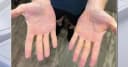 TIL a man who ate between 6-9 pounds of cheese, sticks of butter, and hamburgers a day for about 8 months developed xanthelasma and raised yellow lesions caused by cholesterol appeared on his eyelids.