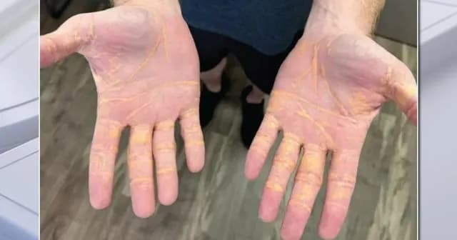 TIL a man who ate between 6-9 pounds of cheese, sticks of butter, and hamburgers a day for about 8 months developed xanthelasma and raised yellow lesions caused by cholesterol appeared on his eyelids.