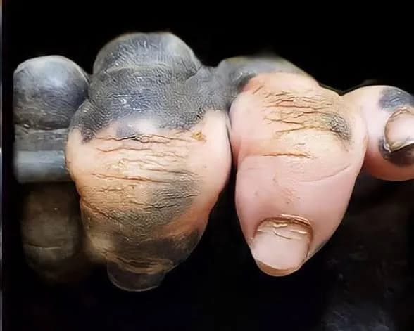 A gorilla displaying vitiligo on its hand