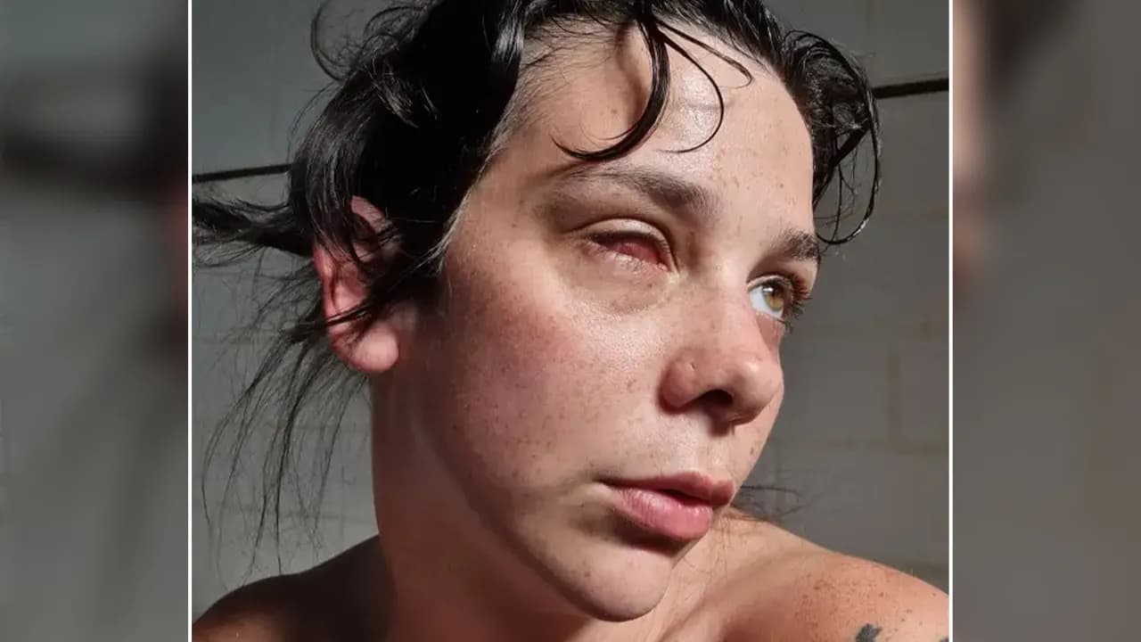 Woman Thinks Her Blurry Vision Is Just A Hangover, Ends Up Losing Her Eye After Doctors Find A Tumor