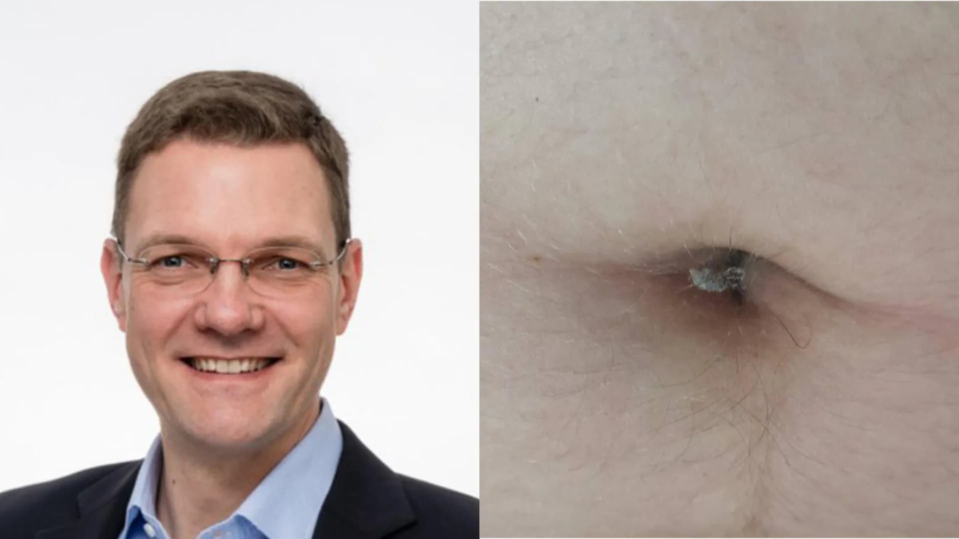Georg Steinhauser, an Austrian chemist, spent three years collecting his own belly button lint for a real published study in 2009. He gathered 503 samples and found that abdominal hair has a barbed, s