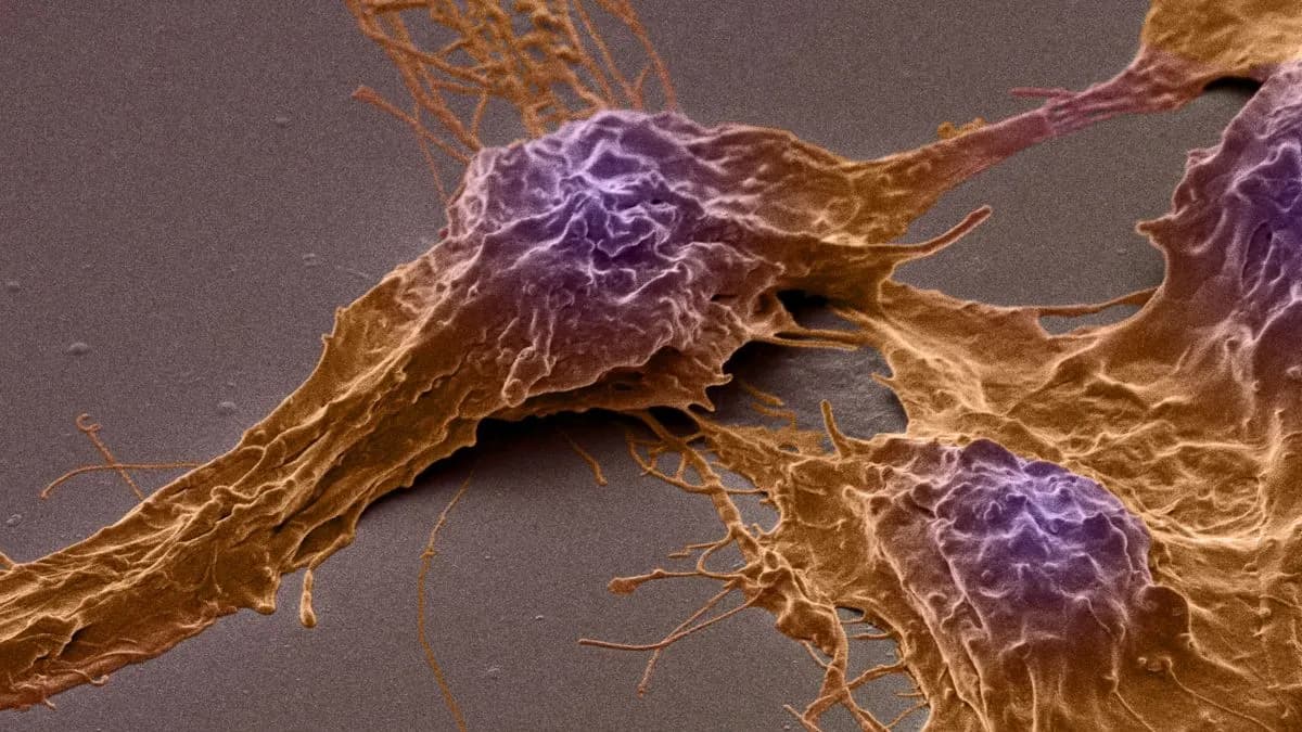 This Deadly Brain Cancer Hijacks Brain Activity to Fuel Its Growth, Study Reveals