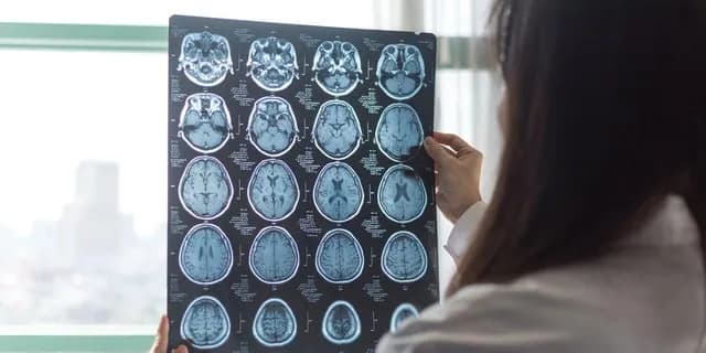 Migraines are linked to accelerated brain aging in regions tied to memory and emotion