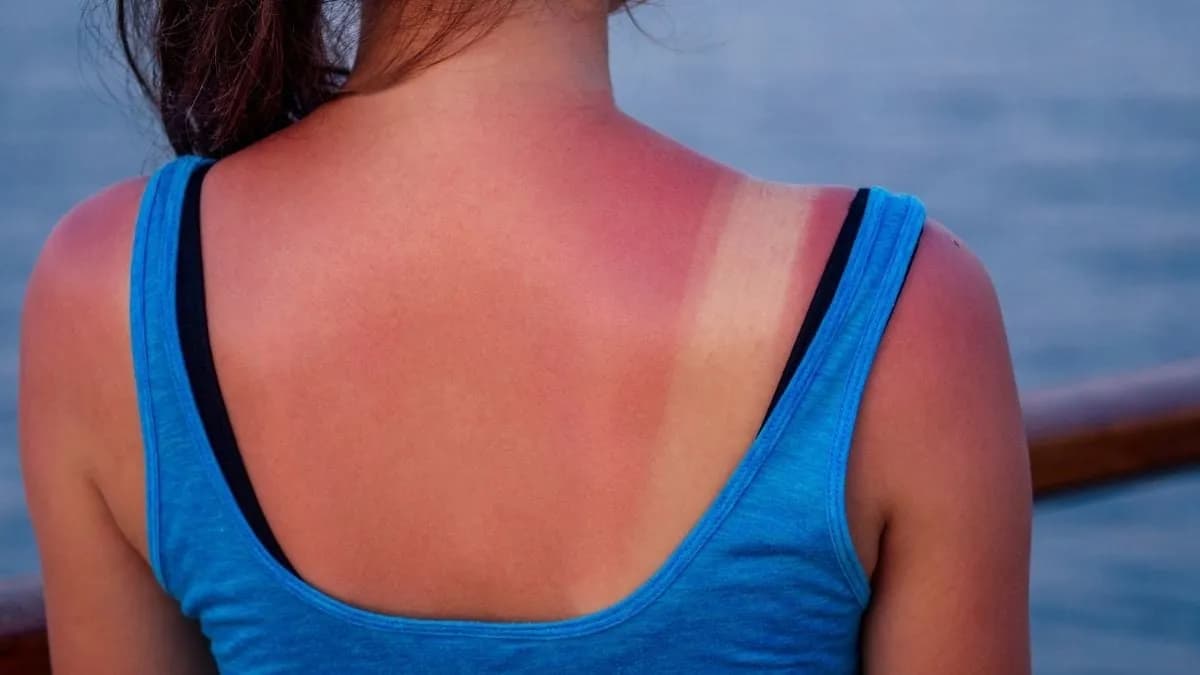 Bad News: Just One Intense Sunburn Really Can Be 'Life-Changing'