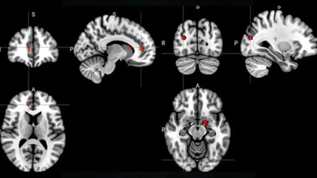 Acupuncture Seems to Rewire The Brain in Depression, Scans Reveal. When comparing the brain scans of people who had been given acupuncture treatments against those on antidepressants: acupuncture seem