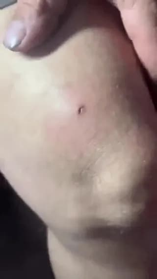 Strong magnet used to remove shrapnel from underneath skin.