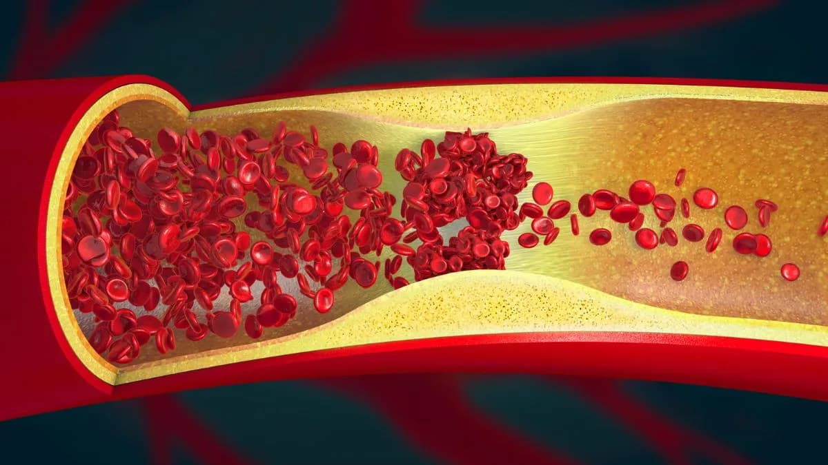 Scientists Find 'Ominous' Signs of Artery Damage in Nearly 8 in 10 Young Adults