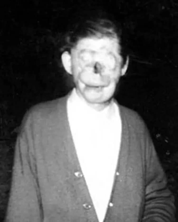 The face of Raymond Robinson, a man who lost his facial features being electrocuted with 22,000 thousand volts when he was 8 y/o. He lost both his eyes,nose and right arm in the incident.