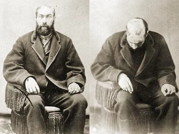 The scalp of William Thompson who got scalped in 1867 and is now in the Omaha public library collection.