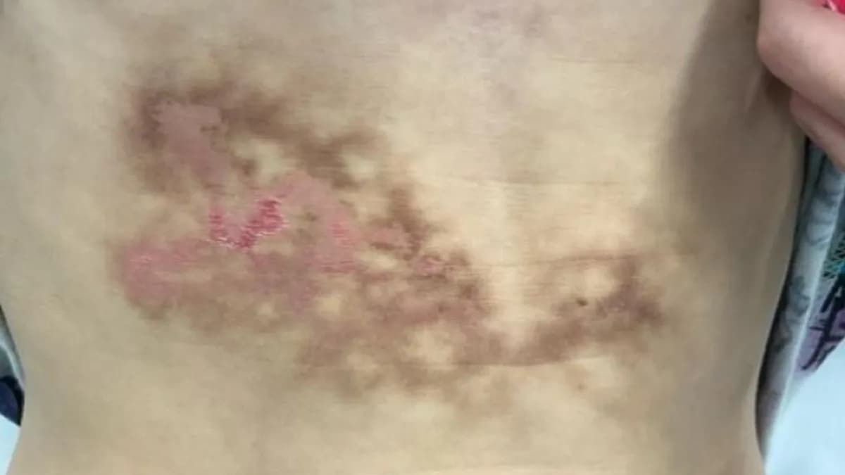 Bizarre Rash Was Thought to Be a Liver Injury, But It Was Caused by a Common Habit