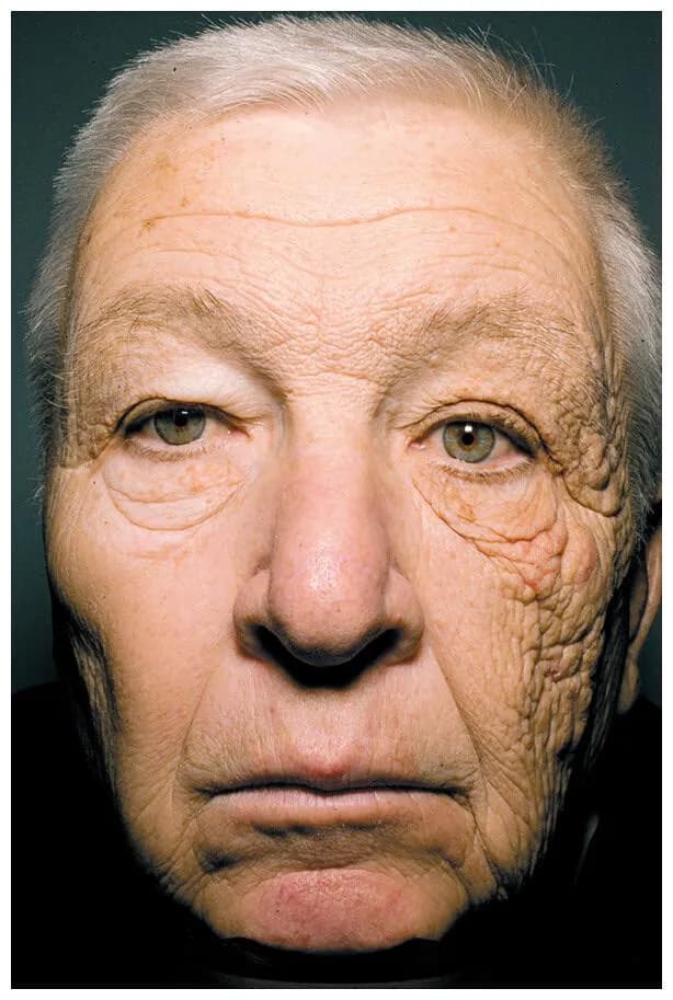 A truck driver's face after 28 years of sun coming through his side window. Only the window side aged.