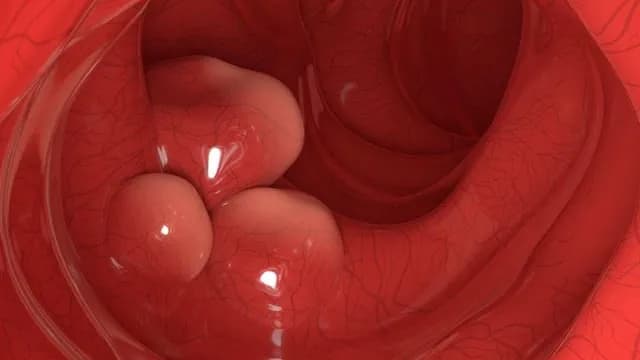 Engineered Probiotic Wipes Out 43% of Colorectal Tumors in Mice: The engineered E Coli packed a triple-whammy โ chemotherapy produced directly inside the tumor, an immune stimulant, and a localized fo