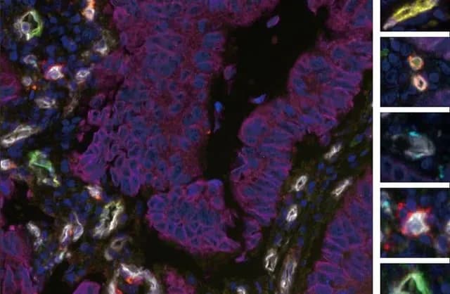 Blood vessel features in tumors may help predict patient survival in colorectal cancer